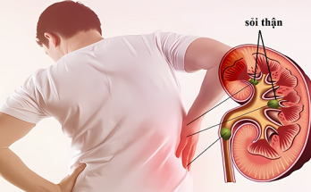 Người mắc bệnh sỏi thận nếu không điều trị kịp thời có thể có những biến chứng nguy hiểm, thầm lặng vì viên sỏi sẽ to lên và cản trở đường bài tiết nước tiểu, làm cho chức năng thận hư hại dần. Do vậy, khi có những triệu chứng như trên thì nên đi khám ngay.