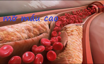 Mỡ máu cao có thể gây ra sự tích tụ chất béo trên thành mạch máu, gây tắc nghẽn động mạch và dẫn đến các vấn đề sức khỏe như huyết áp cao, đột quỵ, nhồi máu cơ tim, bệnh tim mạch, và đái tháo đường.