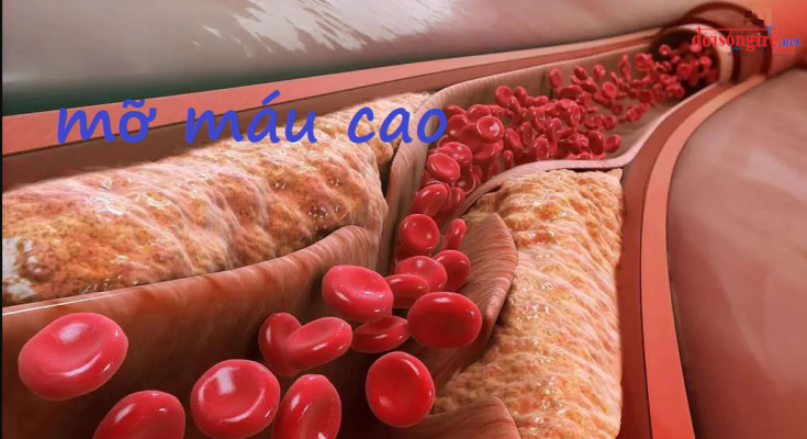 Mỡ máu cao có thể gây ra sự tích tụ chất béo trên thành mạch máu, gây tắc nghẽn động mạch và dẫn đến các vấn đề sức khỏe như huyết áp cao, đột quỵ, nhồi máu cơ tim, bệnh tim mạch, và đái tháo đường.
